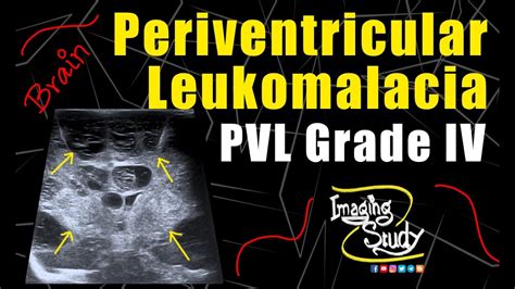 what does pvl stand for ultrasound